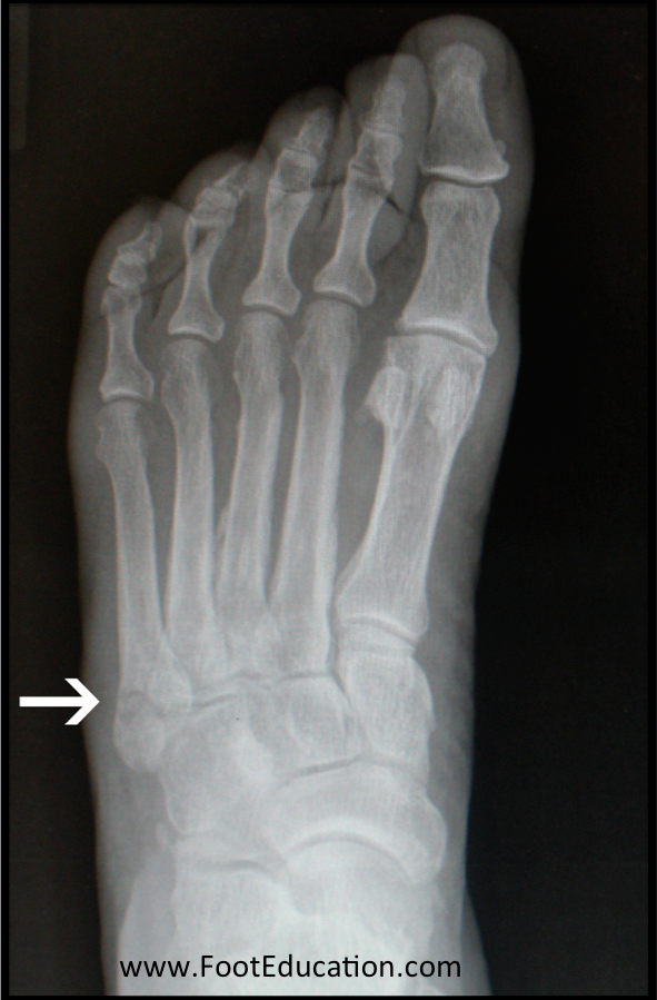5th Metatarsal Avulsion Fracture FootEducation