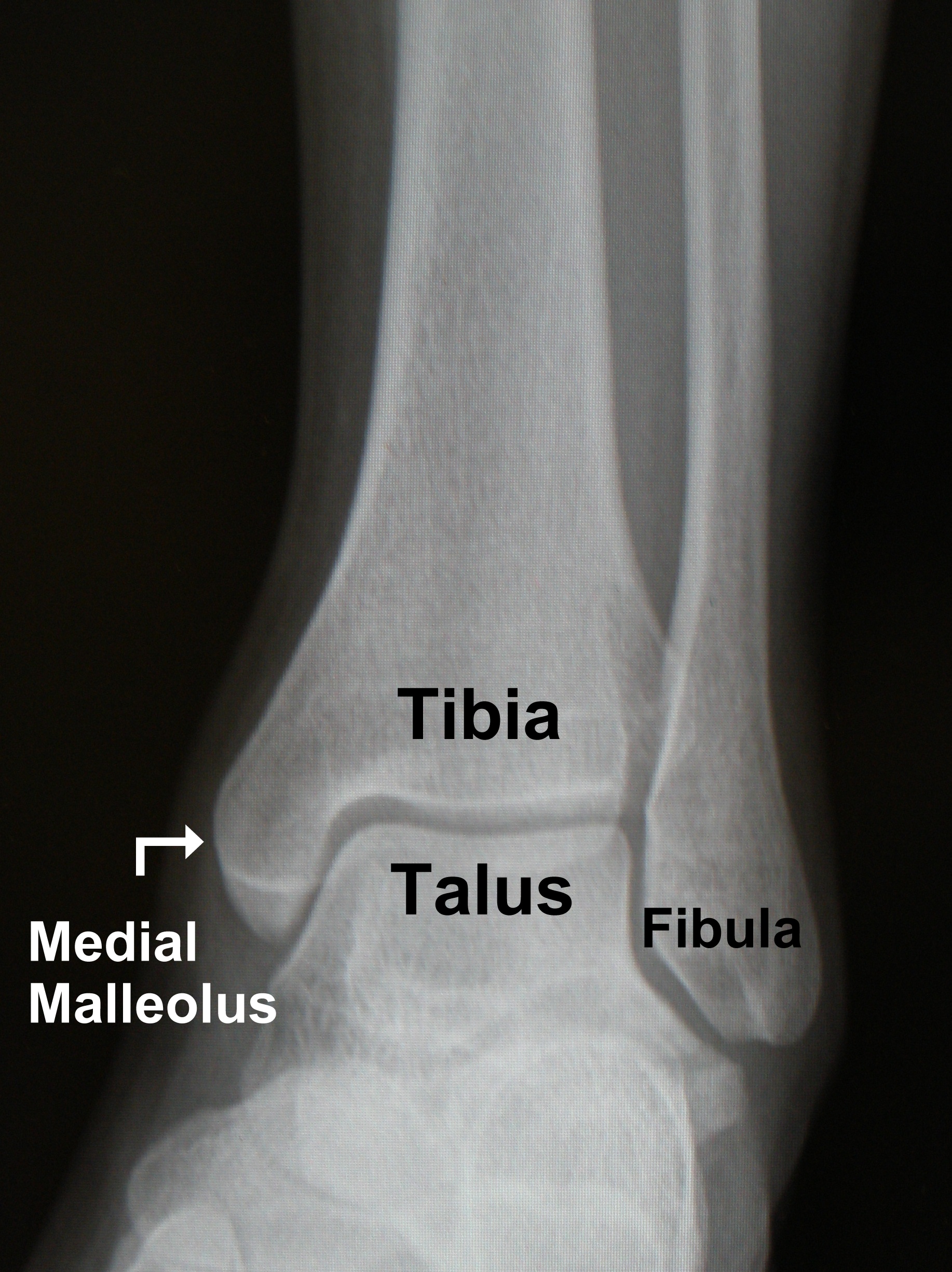 Ankle Fracture FootEducation