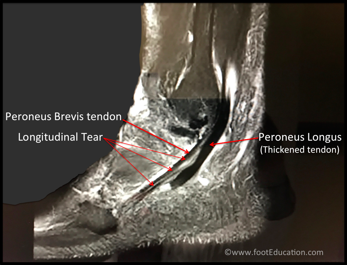 Peroneal Tendonitis FootEducation