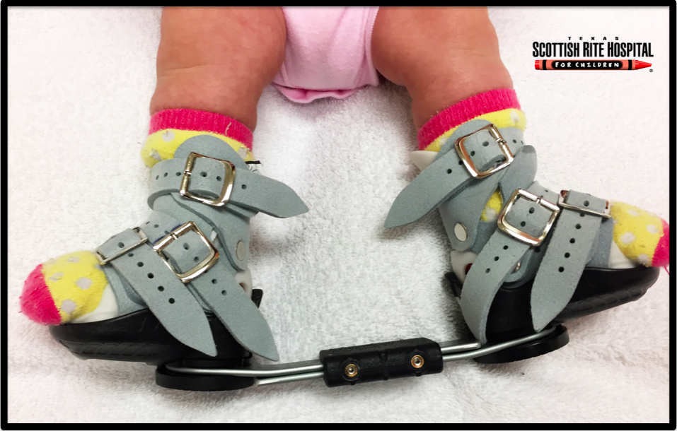 Clubfoot Deformity FootEducation